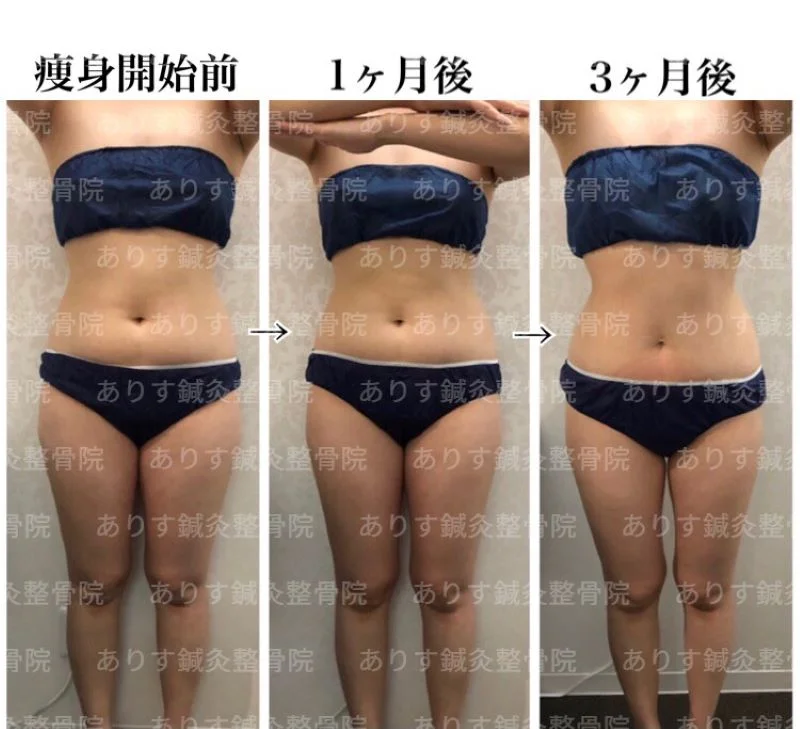 予約殺到！！脂肪冷却モニターとは？？高松市ビューティーアリスでお得